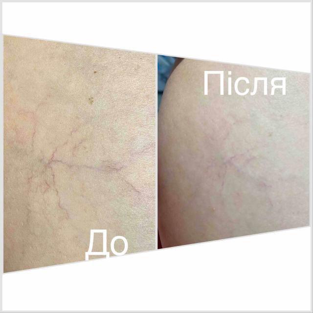 Видалення судин лазером